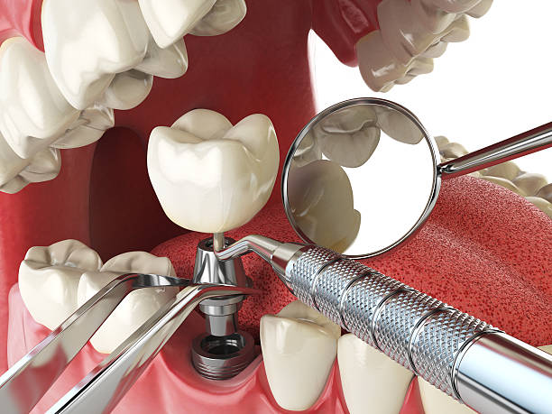 Best Emergency Dentist for Knocked-Out Tooth in Creston, OH